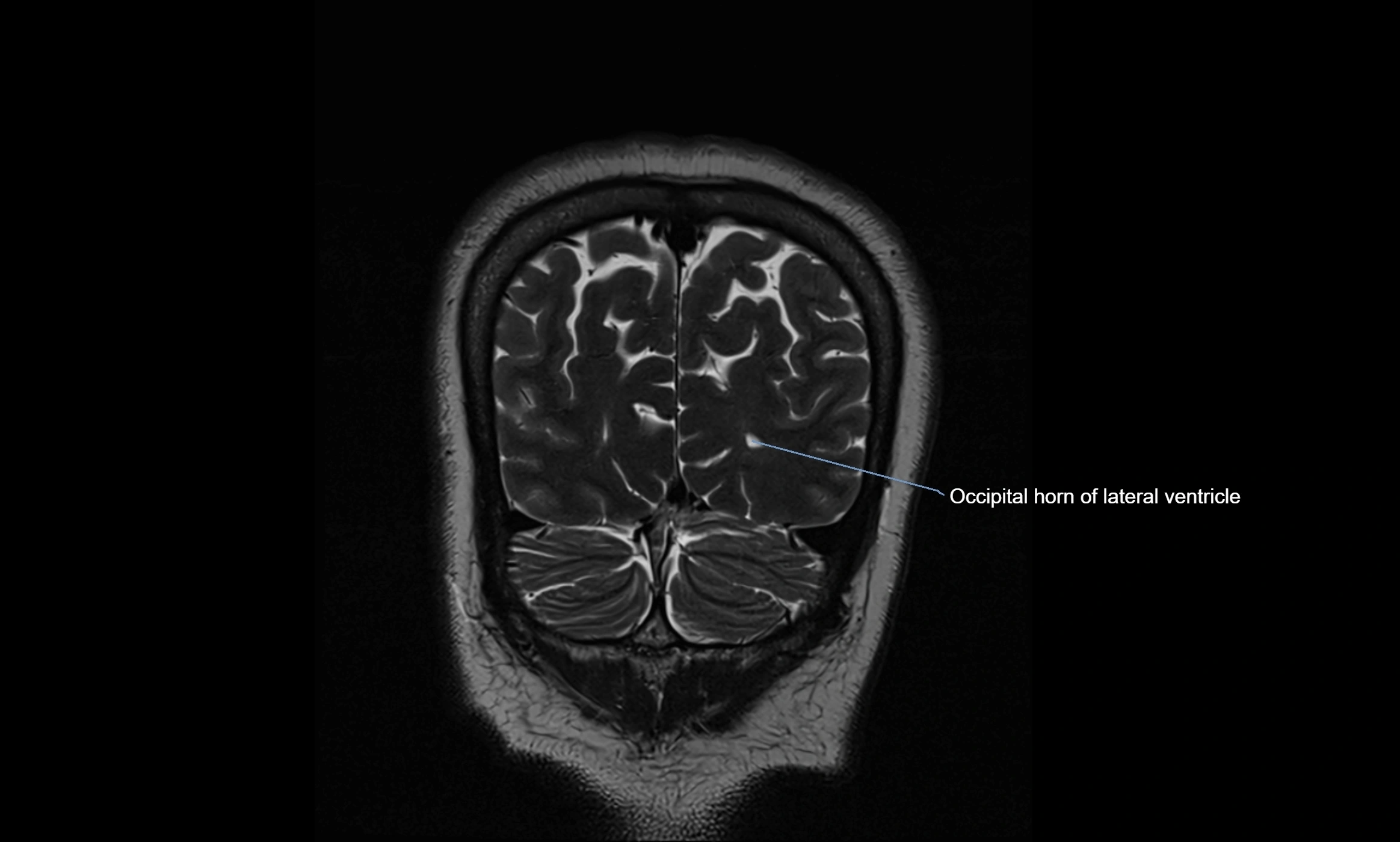 Brain cisterns  and ventricles coronal anatomy 3T MRI image-img-00001-00055.webp